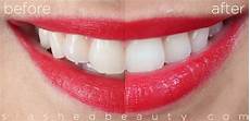 crest whitestrips supreme review review with before after crest 3d white whitestrips crest whitestrips supreme review review with before after crest 3d white whitestrips