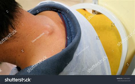 Image result for Sebaceous Cyst On Back