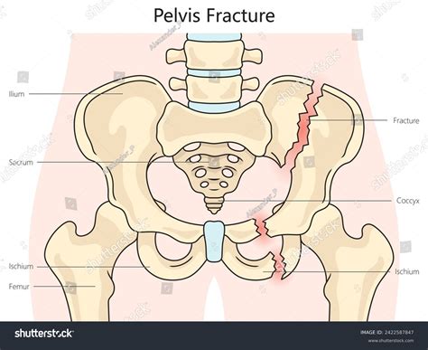 Pelvic Pelvis Fracture Structure Diagram Hand Stock Illustration 2422587847 | Shutterstock