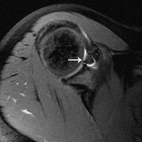 Sensitivity and Specificity in Detection of Labral Tears with 3.0-T MRI ...