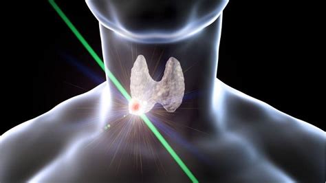 Your Thyroid Ablation Journey: Before, During and After Treatment ...
