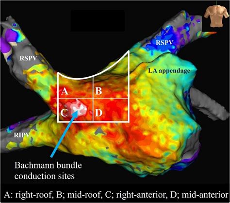 PO-03-063 THE CONNECTION SITE OF THE BACHMANN BUNDLE TO THE LEFT ATRIUM ...