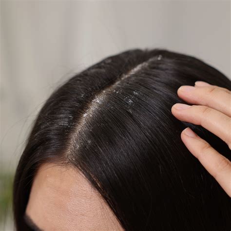 What is a Moldy Scalp? Here are the Signs & How to Fix it