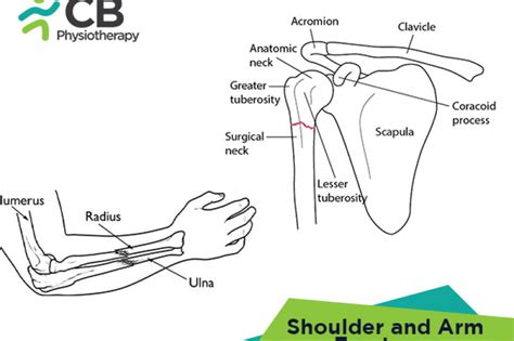 What are Shoulder and Arm Fractures? Symptoms, Causes, Diagnosis ...