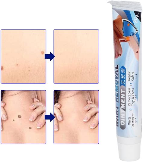 LIZEALUCKY Removedor de verrugas pomada portátil para eliminar verrugas faciales verrugas ...
