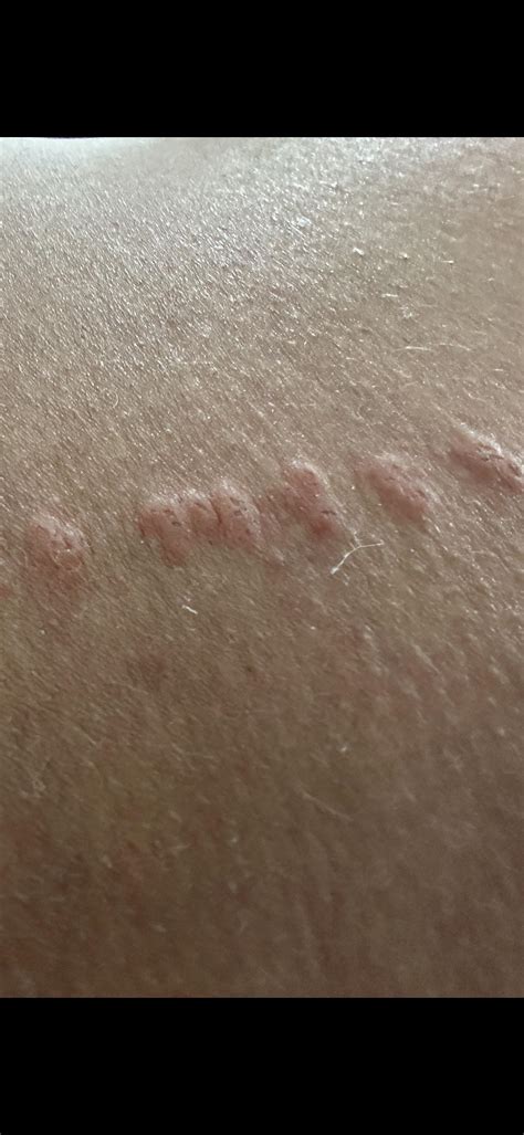 Several bumps down leg : r/DermatologyQuestions