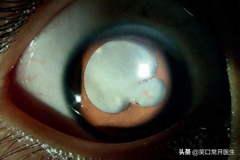 8岁男童右眼出现白瞳、视网膜脱落，几乎失明，医生：眼里有虫子 - 知乎