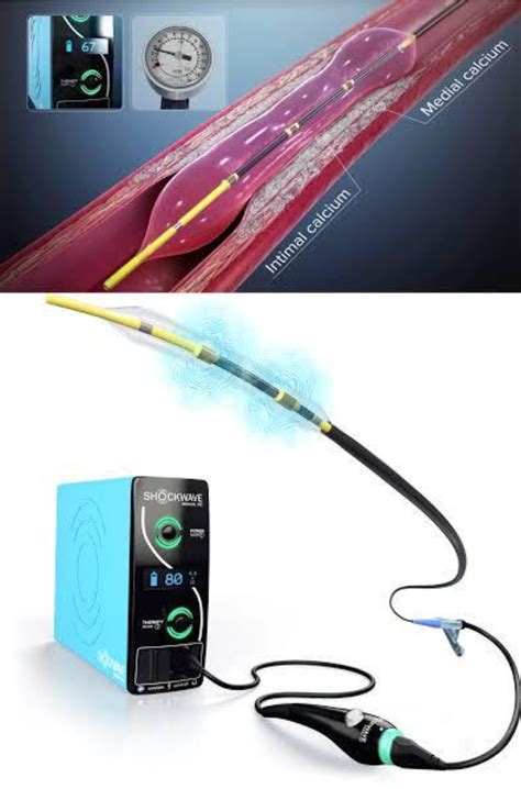 Intravascular shock wave lithotripsy, or IVL, is a medical procedure ...