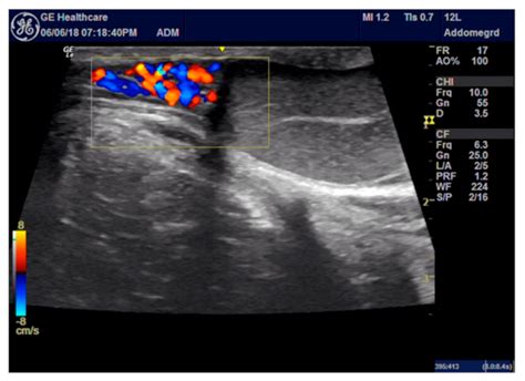 Ultrasound-Guided Funicular Block: Ropivacaine Injection into the ...