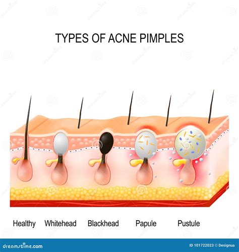 Types of acne pimples stock vector. Illustration of comedo - 101722023