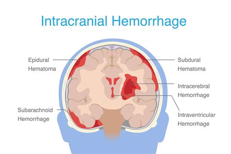 Brain Aneurysm vs. Hemorrhage | Supreme Vascular and Interventional Clinic