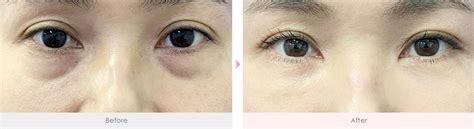 お顔の老け見えリセット！クマ取り女神による若返り特集｜美容整形・美容外科・美容皮膚科なら湘南美容クリニック【公式】