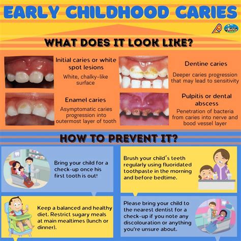 Early childhood caries – Malaysian Association of Paediatric Dentistry