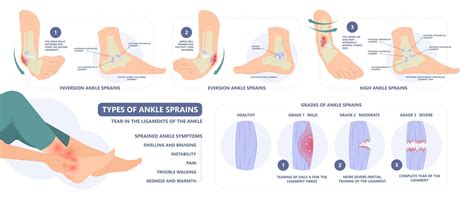 Sprained Ankle: Symptoms, Diagnosis, Physical Therapy