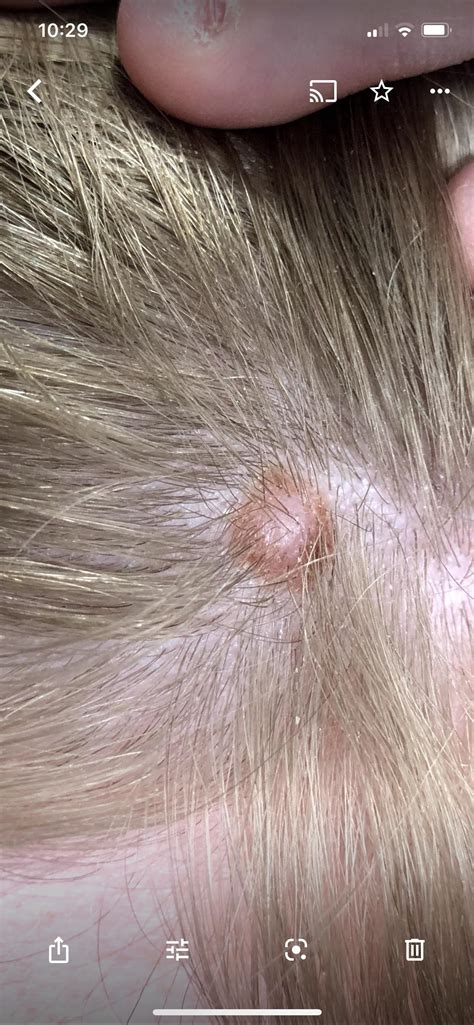 Skin Cancer Mole On Head at Joe Alvarez blog