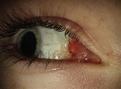Pyogenic Granuloma Eye Treatment