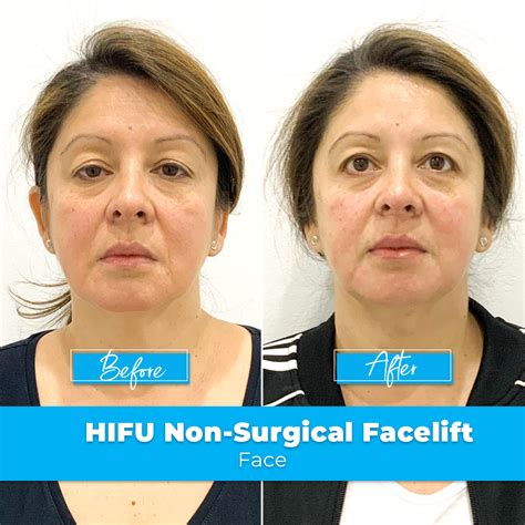 HIFU Non-Surgical Facelift | Sydney | Elite Body Contouring