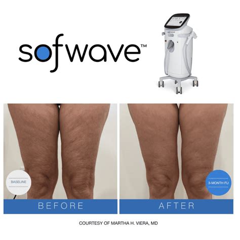 Smooth Cellulite with Sofwave™ - Burnsville MN & Lakeville MN