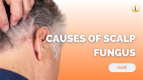 Fungus On Scalp