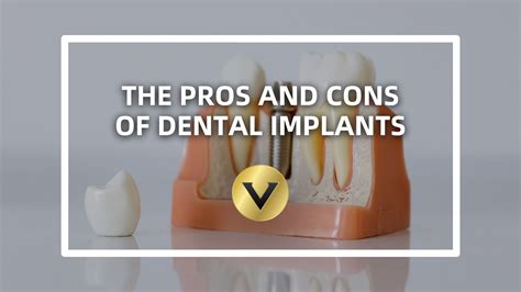 The Pros and Cons of Dental Implants | Dental implants, Restorative dentistry, Dentistry