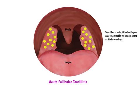 Swollen Lymph Nodes In Neck And White Spots On Tonsils Images - Infoupdate.org