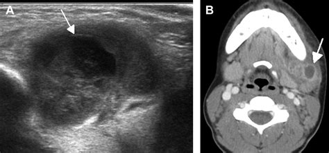 Ultrasonography of Cervical Lymph Nodes - Radiologic Clinics