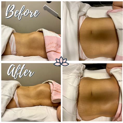 Brazilian Lymphatic Massage Benefits | Lympha Spa & Massage