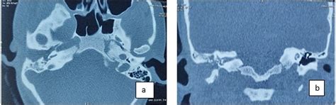 Keratosis obturans masquerading as cholesteatoma- A case report - J ...