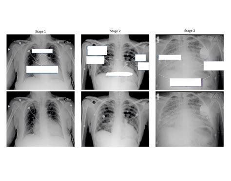 CXR- Cardiogenic Pulmonary Edema Stages 1-3 Quiz