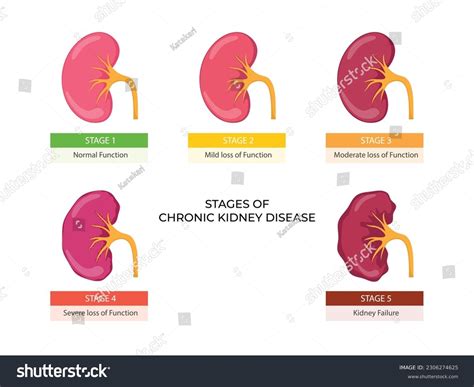 Stages Chronic Kidney Disease Problem Urinary Stock Vector (Royalty Free) 2306274625 | Shutterstock