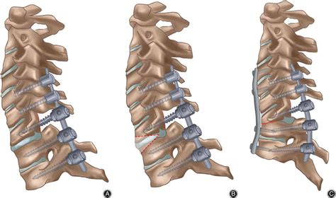 Spine Surgery: Meaning, Types and Risk Factors