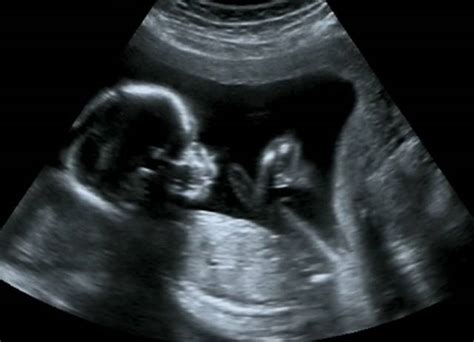 怀孕4个月鉴别男女技巧，为什么16周看的女孩后来翻盘成了男孩