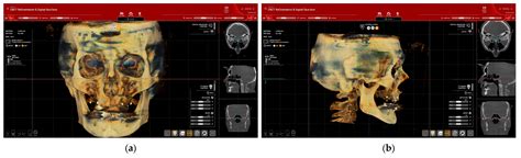 Predictable Full Digital Workflow Using Stackable Surgical Templates ...