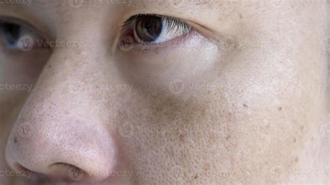 Close up Asian man face with freckles dark spots from uv light , skin ...