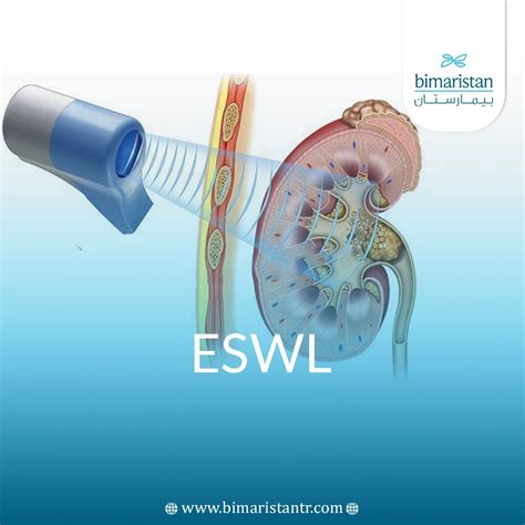 ESWL (Extracorporeal Shock Wave Lithotripsy) in Turkey
