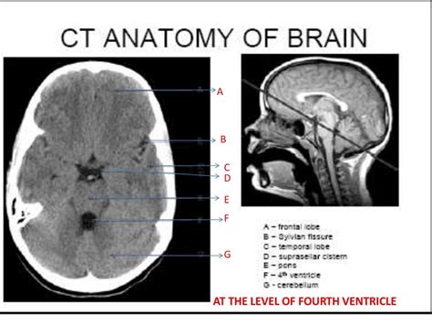 Image result for Normal Brain CT Scan