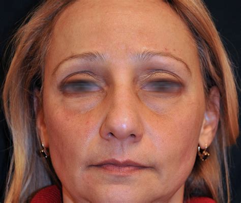 Before & After Photos Brown Spot & Discoloration Removal 7 | NYC