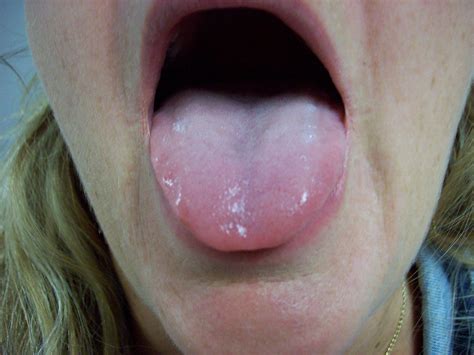 Healthy Tongue Color