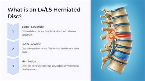 Disability For an L4/L5 Herniated Disc - Benefits.com - We Make ...