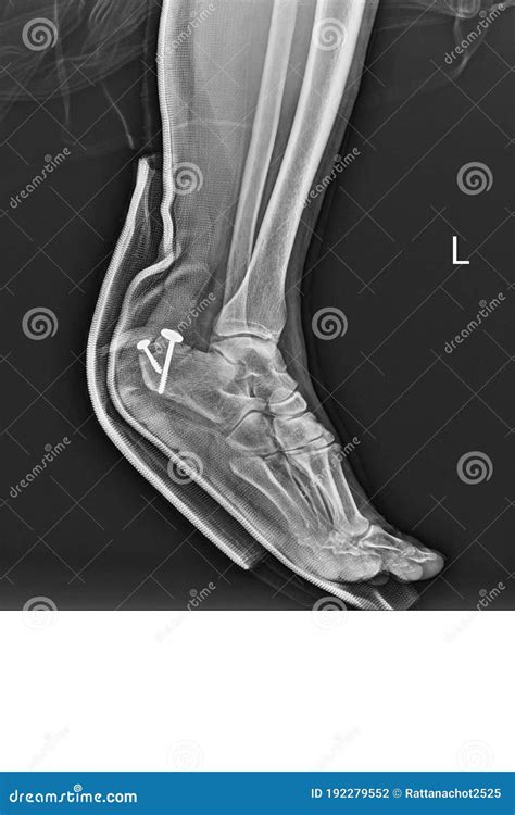 Film Ankle X-ray Radiograph Showing Heel Bone Broken Close Fracture ...