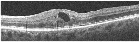 Sarcoidosis-Related Uveitis: A Review