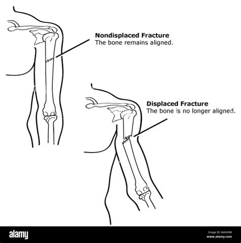 Displaced fracture hi-res stock photography and images - Alamy