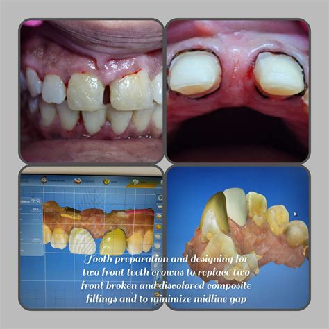 Types Of Diastema And Treatment For Fixing Gaps In Teeth - UQCC