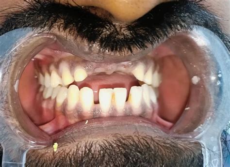 Dental Crowns and Bridges in Wakad | Narhare Dental Clinic