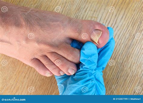 Ingrown Toenail on Foot. Doctor Examines Thumb Stock Image - Image of medical, healthcare: 215307799
