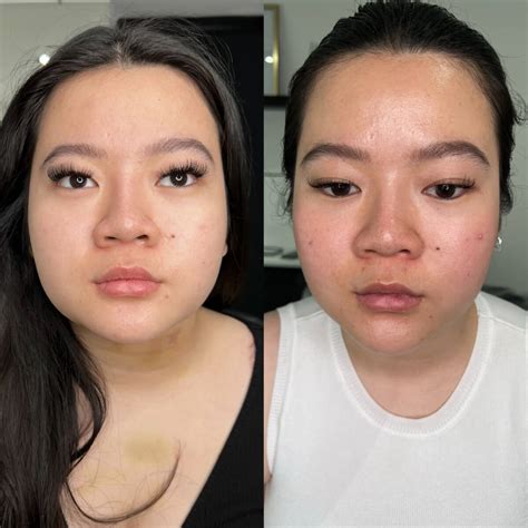 Masseter Jawline Slimming Botox - Faces By Bae