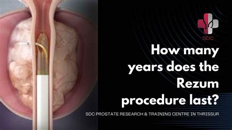 How Many Years Does the Rezum Procedure Last? – sdcprostatecentre.com