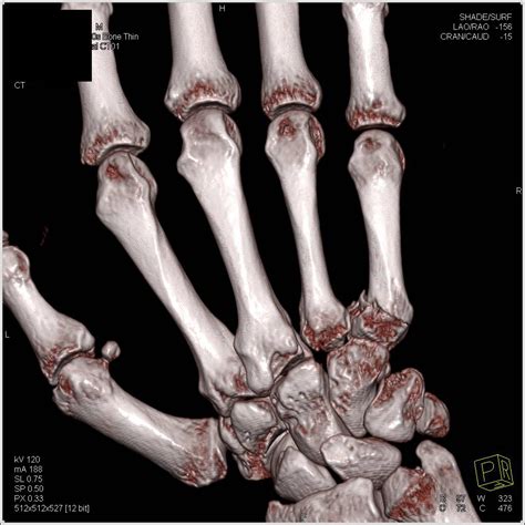 Fracture Base of 5th Metacarpal - Musculoskeletal Radiology Case ...