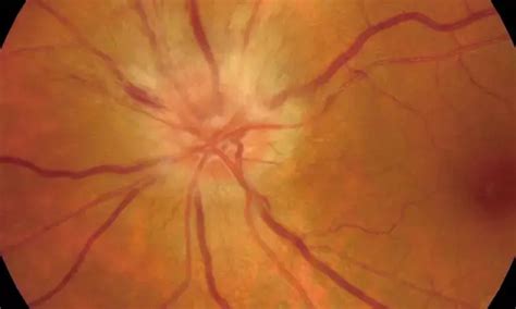Semaglutide and Liraglutide linked to Elevated Risk of Optic Nerve ...