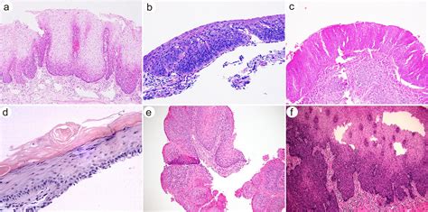Histomorphology and Molecular Profiling of Well-Differentiated Squamous Cell Carcinoma of the ...